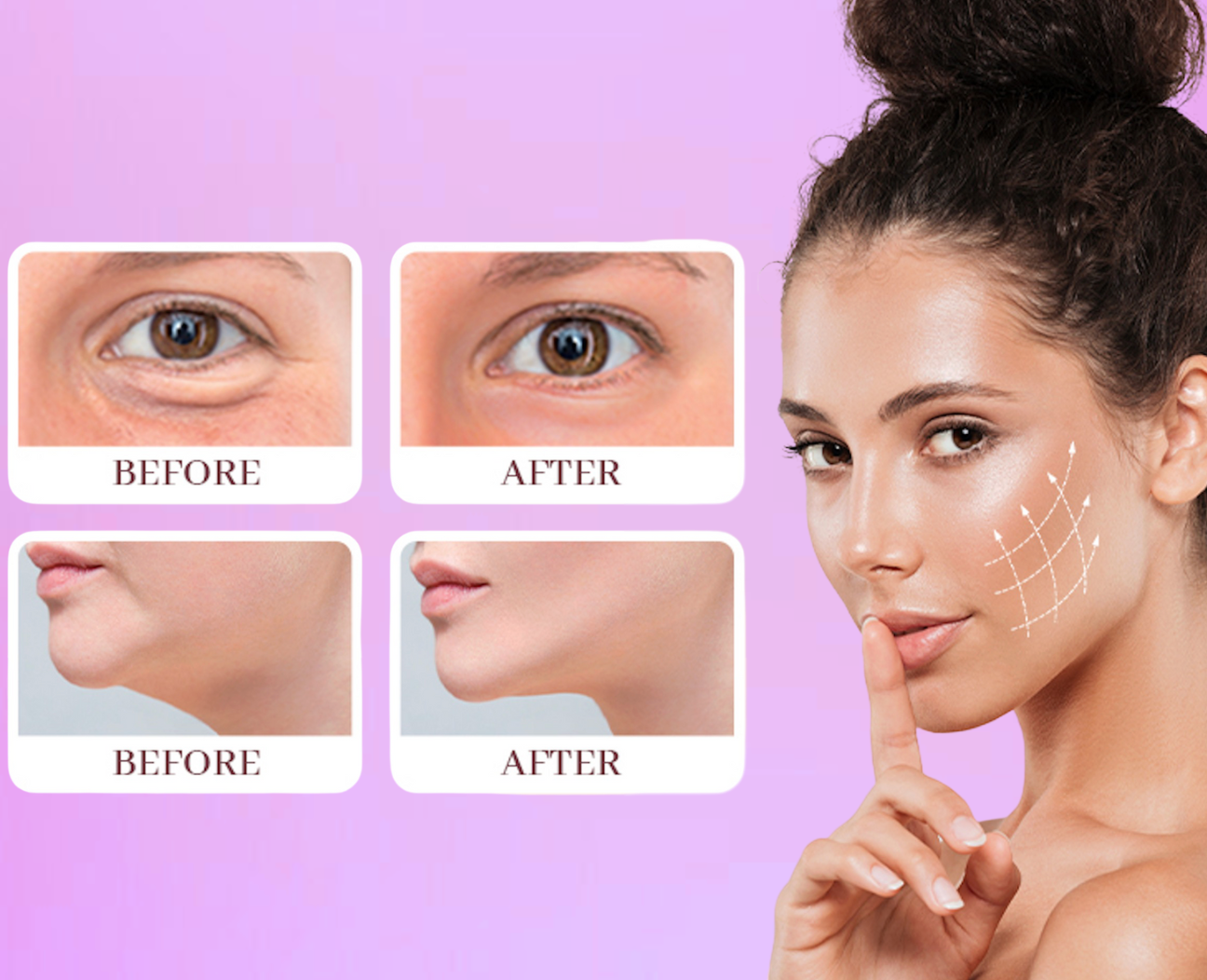 MyFaceLift