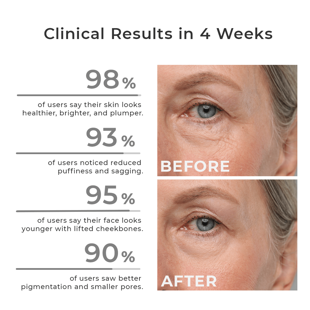 MyFaceLift